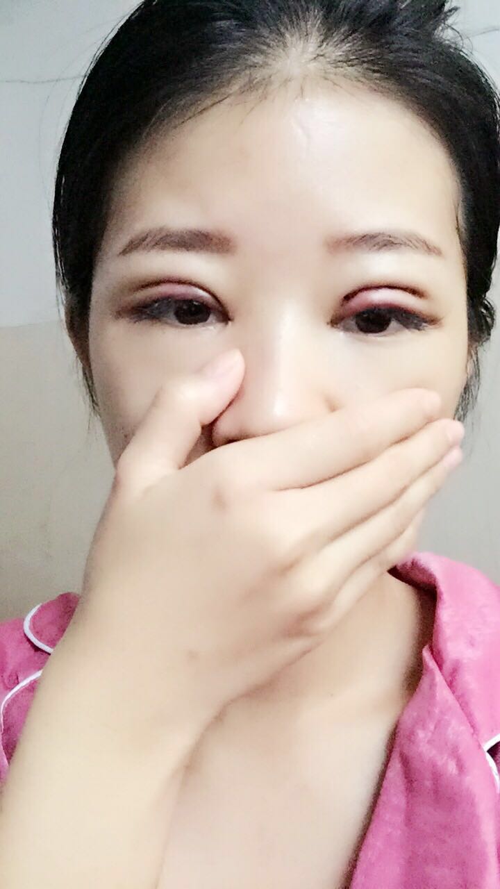 深圳晨曦醫(yī)療整形醫(yī)生吉米斯做切開(kāi)雙眼皮怎么樣？吉米斯切開(kāi)雙眼皮案例效果