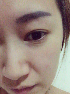 重慶五洲女子醫(yī)院整形美容中心做光子嫩膚怎么樣？淡明斌醫(yī)生光子嫩膚案例