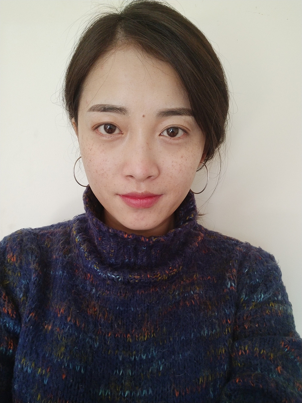重慶當代整形李敏旭醫(yī)生做皮秒激光祛斑效果怎么樣？附皮秒激光祛斑案例
