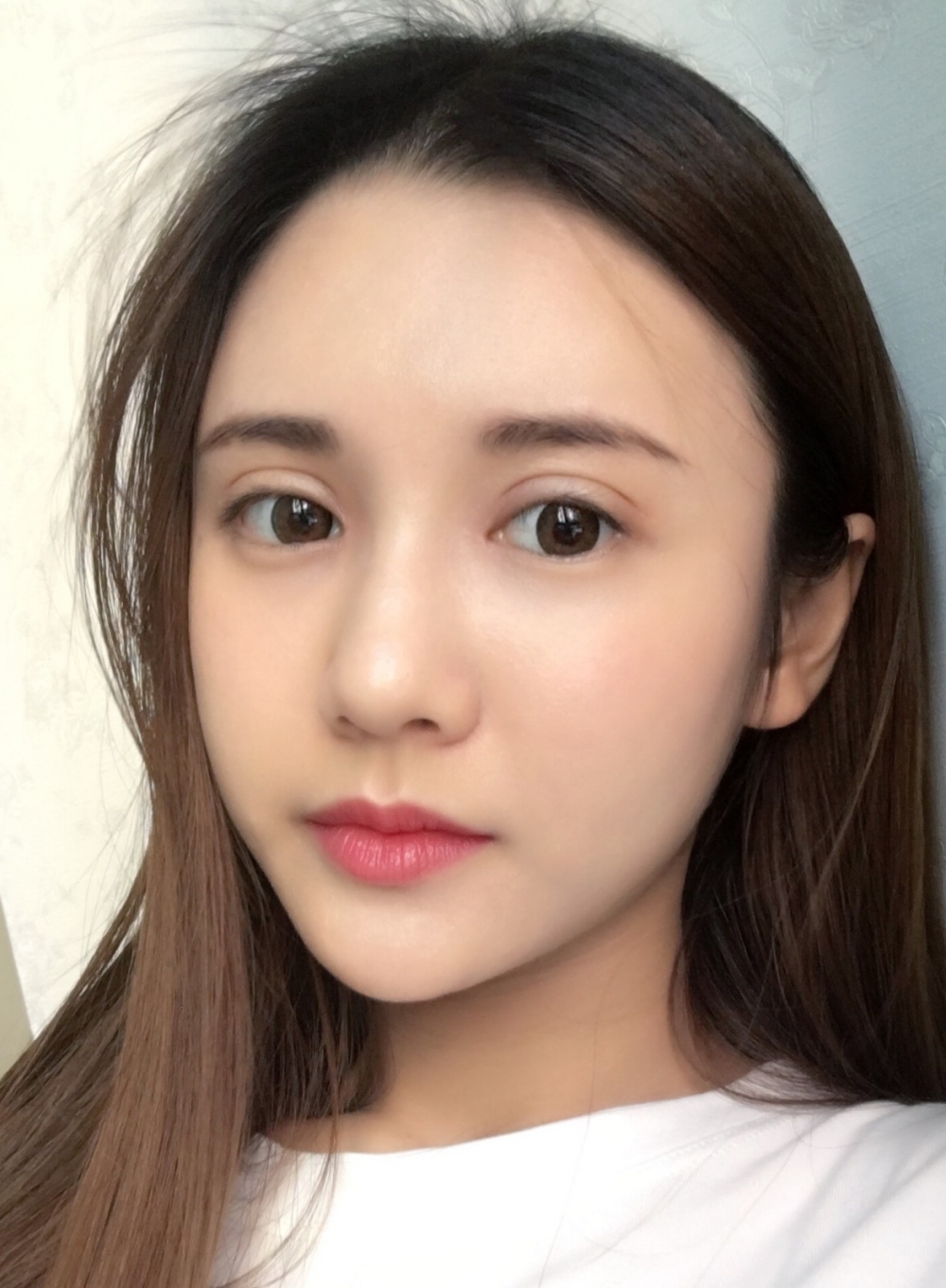 鄭州銘藝整形醫(yī)生陳濤做切開雙眼皮怎么樣？鄭州銘藝切開雙眼皮案例