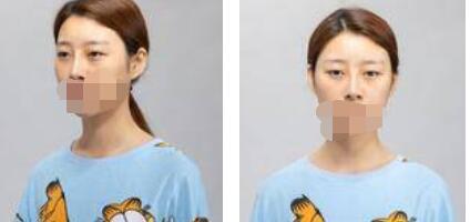 太原歐美蓮整形醫(yī)院丁曉峰醫(yī)生做雙眼皮怎么樣？丁曉峰雙眼皮手術(shù)案例分享