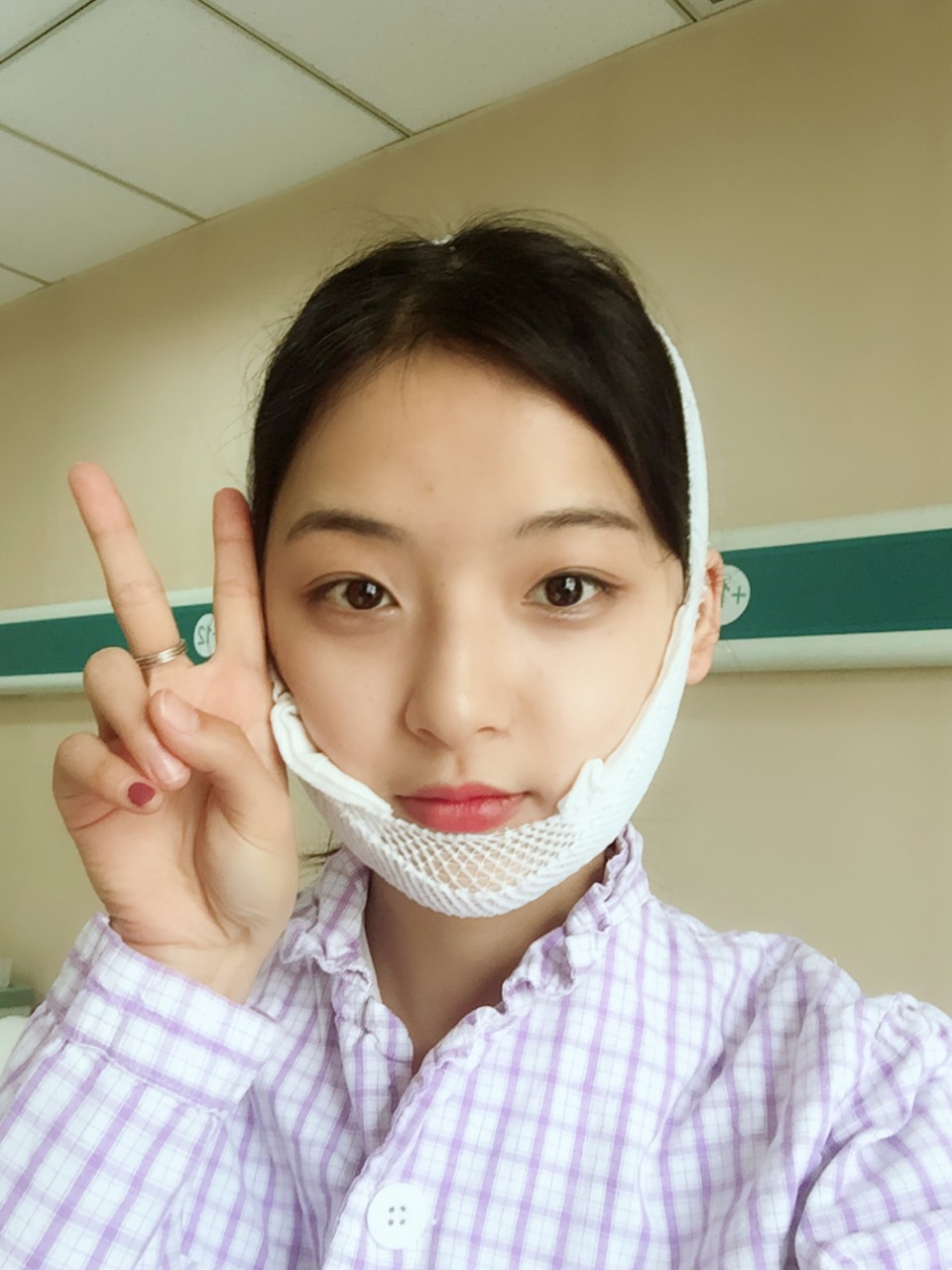 鄭州名門整形醫(yī)院董斌醫(yī)生做下頜角整形怎么樣？附下頜角整形案例