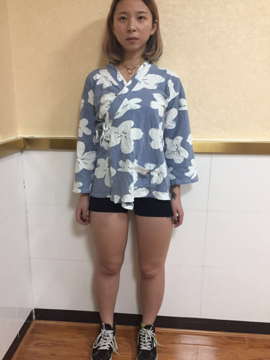 深圳鵬愛醫(yī)療整形醫(yī)生張建文做大腿吸脂怎么樣？附大腿吸脂案例效果對(duì)比圖