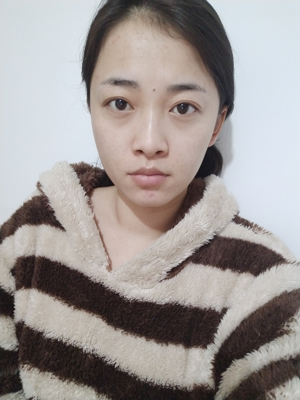 重慶當代整形李敏旭醫(yī)生做皮秒激光祛斑效果怎么樣？附皮秒激光祛斑案例