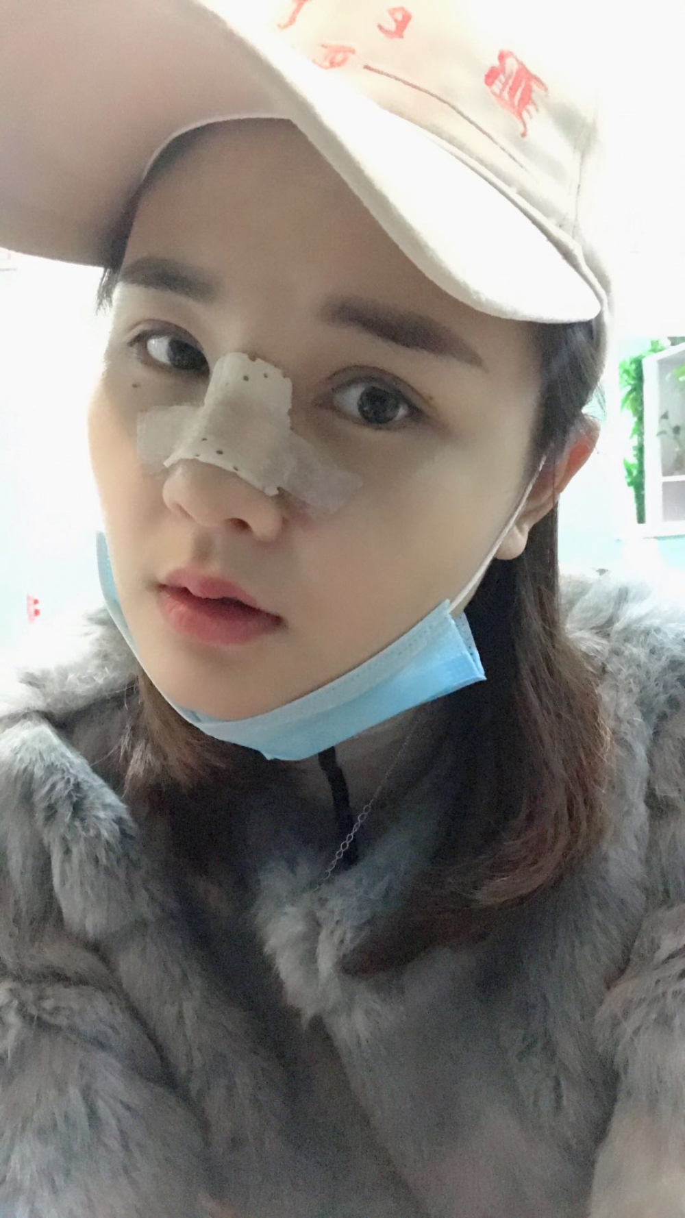 鄭州華領(lǐng)醫(yī)療美容醫(yī)院賀小虎醫(yī)生做眼綜合+鼻部整形手術(shù)效果怎么樣？