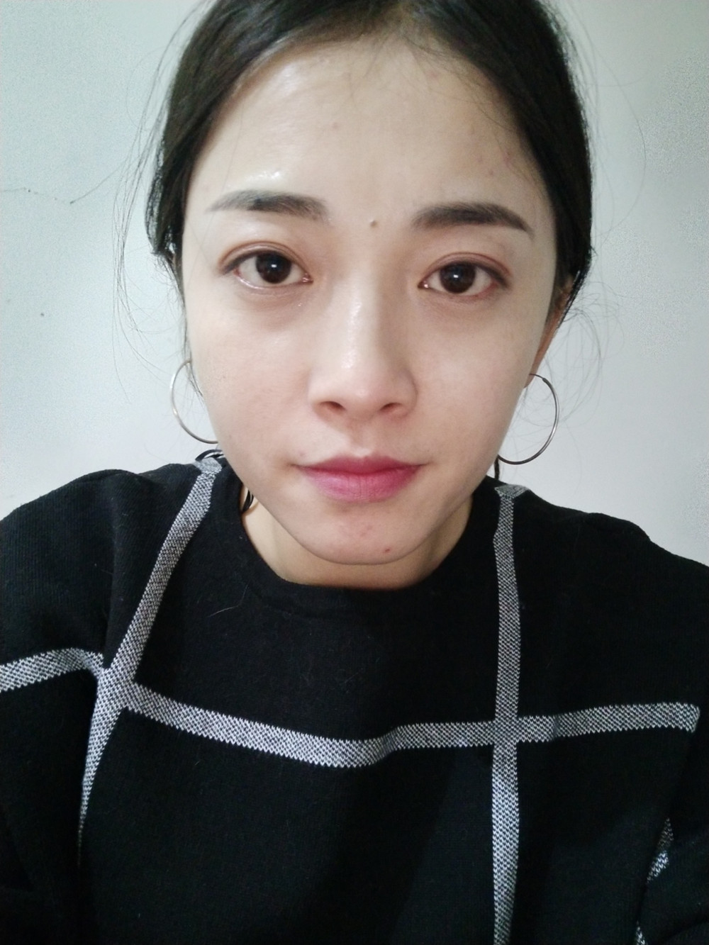 重慶當代整形李敏旭醫(yī)生做皮秒激光祛斑效果怎么樣？附皮秒激光祛斑案例