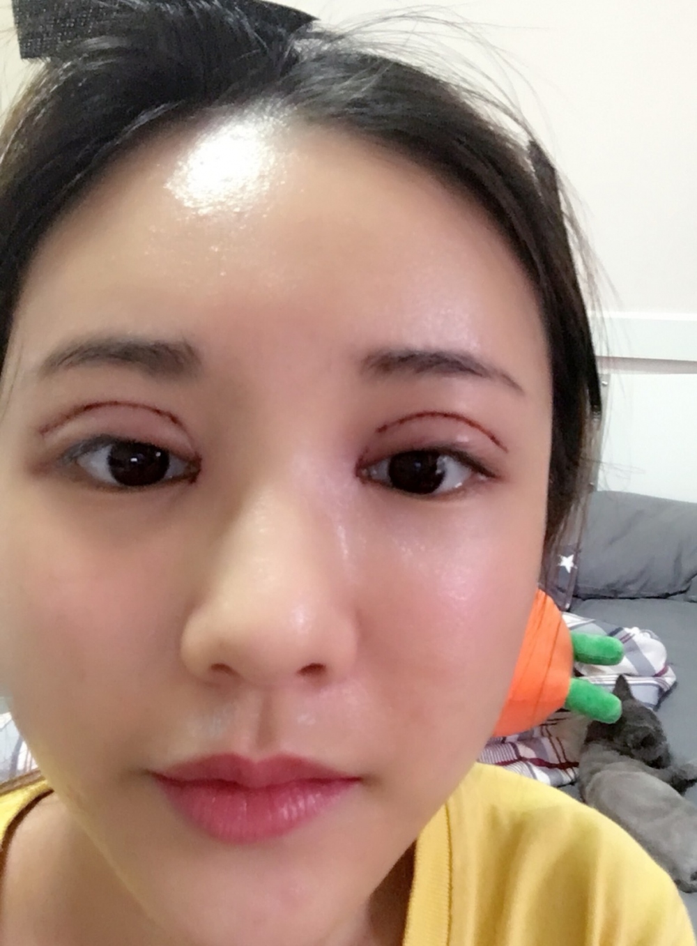 鄭州銘藝整形醫(yī)生陳濤做切開雙眼皮怎么樣？鄭州銘藝切開雙眼皮案例
