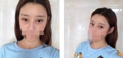 太原歐美蓮整形醫(yī)院丁曉峰醫(yī)生做雙眼皮怎么樣？丁曉峰雙眼皮手術(shù)案例分享