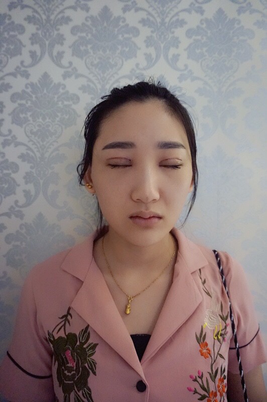 武漢中翰整形外科醫(yī)院沈磊醫(yī)生做切開雙眼皮怎么樣？附沈磊切開雙眼皮案例