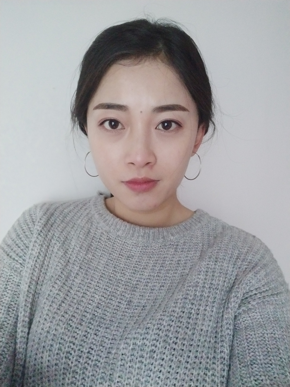 重慶當代整形李敏旭醫(yī)生做皮秒激光祛斑效果怎么樣？附皮秒激光祛斑案例