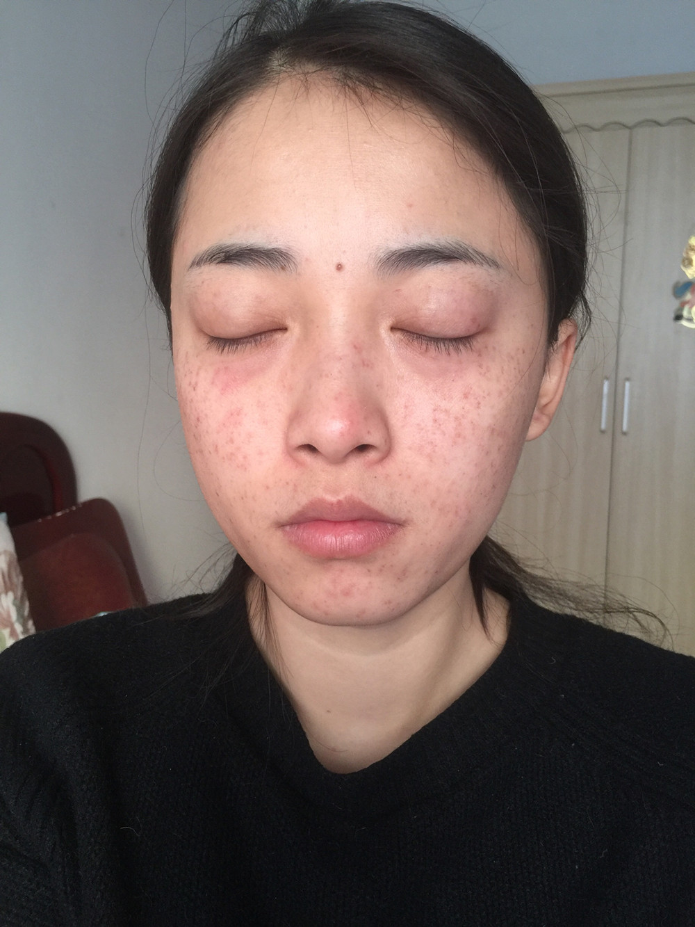 重慶當代整形李敏旭醫(yī)生做皮秒激光祛斑效果怎么樣？附皮秒激光祛斑案例