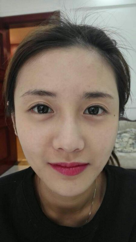 鄭州銘藝整形醫(yī)生陳濤做切開(kāi)雙眼皮怎么樣？鄭州銘藝切開(kāi)雙眼皮案例