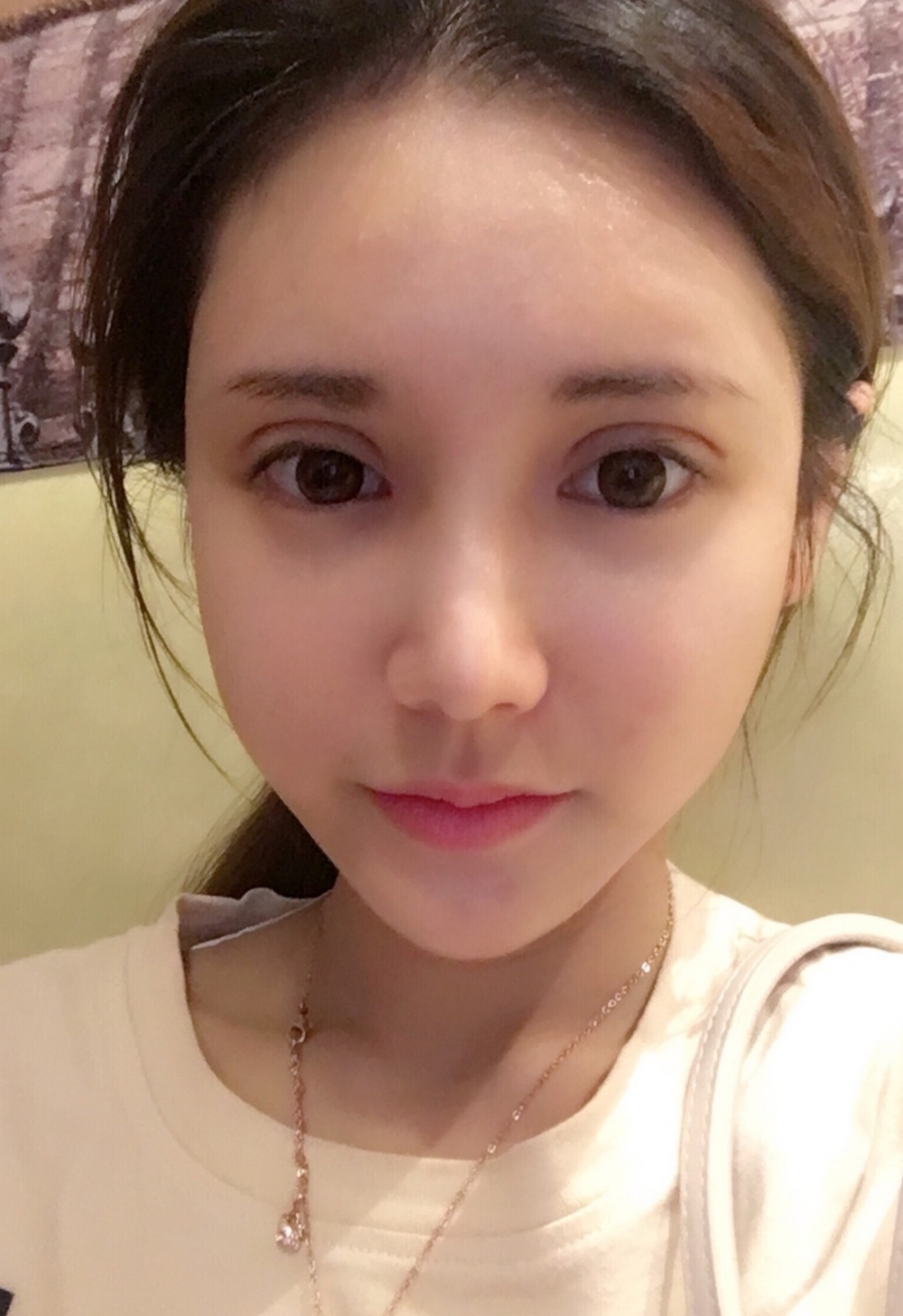 鄭州銘藝整形醫(yī)生陳濤做切開雙眼皮怎么樣？鄭州銘藝切開雙眼皮案例