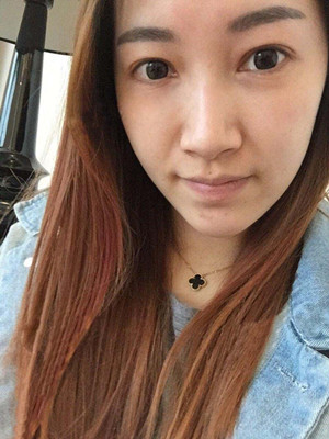 重慶五洲女子醫(yī)院整形美容中心做光子嫩膚怎么樣？淡明斌醫(yī)生光子嫩膚案例