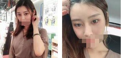 太原歐美蓮整形醫(yī)院丁曉峰醫(yī)生做雙眼皮怎么樣？丁曉峰雙眼皮手術(shù)案例分享