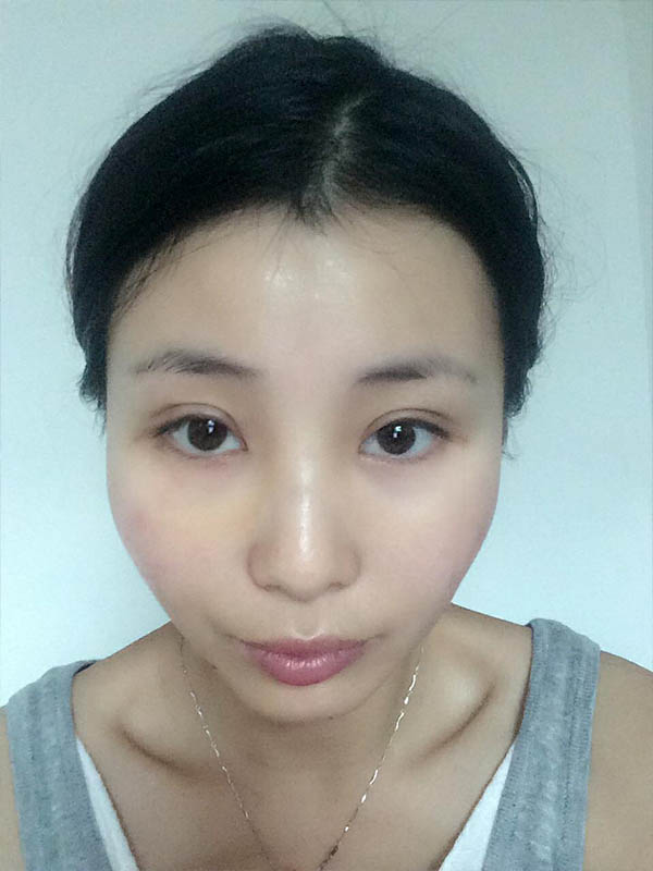 桂林新華醫(yī)療美容醫(yī)生李新華做雙眼皮手術(shù)怎么樣？李新華雙眼皮手術(shù)案例