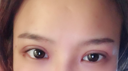 長春麥西美嘉整形醫(yī)生王圣博做雙眼皮手術(shù)效果怎么樣？附雙眼皮案例