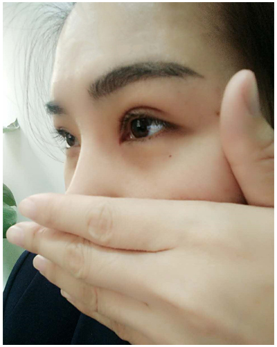 營口臻美醫(yī)療整形醫(yī)生閆迎軍做雙眼皮效果怎么樣？附雙眼皮案例對比圖