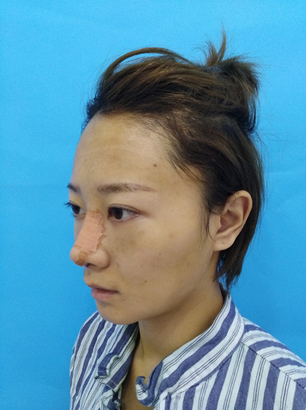 杭州迪美整形常德成醫(yī)生做鼻綜合整形技術(shù)怎么樣？附鼻綜合整形案例