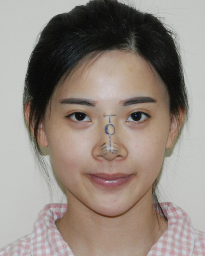 襄陽維多利亞整形醫(yī)院安邰晥醫(yī)生做鼻綜合整形怎么樣？附鼻綜合整形案例