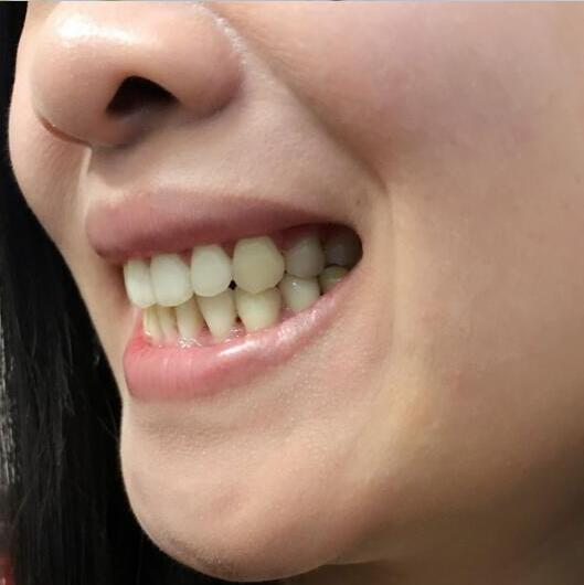 重慶嘉悅口腔醫(yī)院周繼祥醫(yī)生做金屬托槽矯正效果怎么樣？附案例效果對比圖