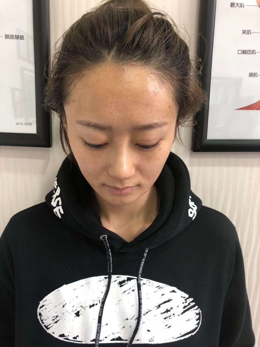 杭州迪美整形常德成醫(yī)生做鼻綜合整形技術(shù)怎么樣？附鼻綜合整形案例