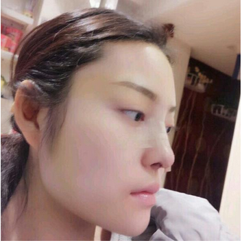 武漢維納斯整形醫(yī)院韓國濤醫(yī)生做鼻綜合整形怎么樣？附鼻綜合整形案例