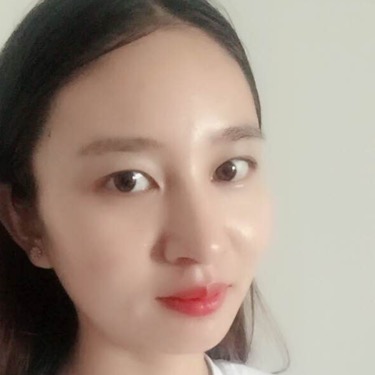 武漢維納斯整形醫(yī)院趙瑾醫(yī)生做玻尿酸墊下巴怎么樣？附玻尿酸墊下巴案例