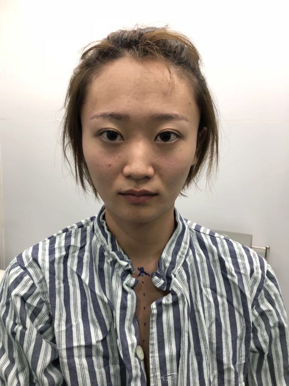 杭州迪美整形常德成醫(yī)生做鼻綜合整形技術(shù)怎么樣？附鼻綜合整形案例
