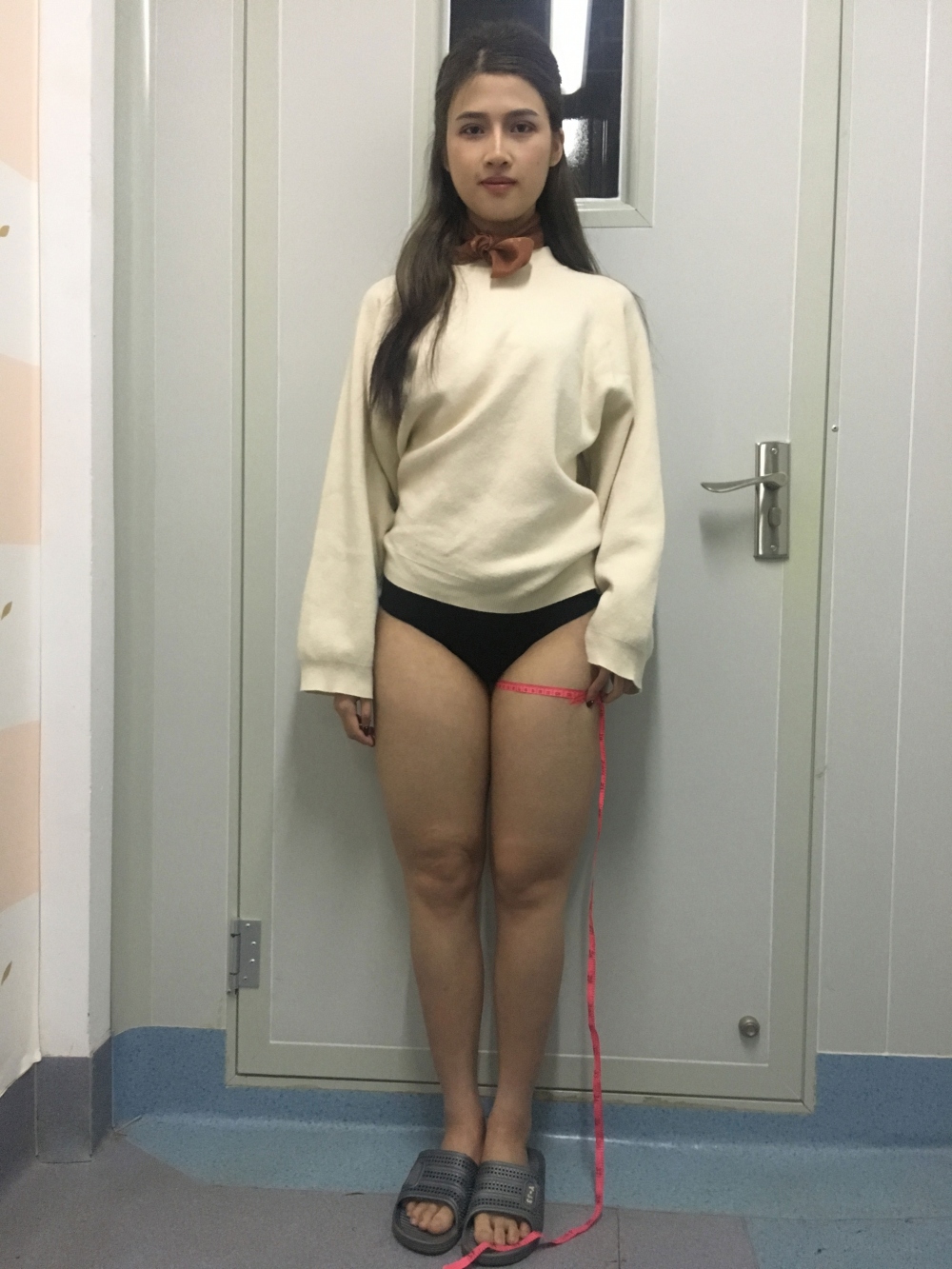 晉城鳳凰整形美容醫(yī)院宋發(fā)興醫(yī)生做大腿吸脂怎么樣？附大腿吸脂案例