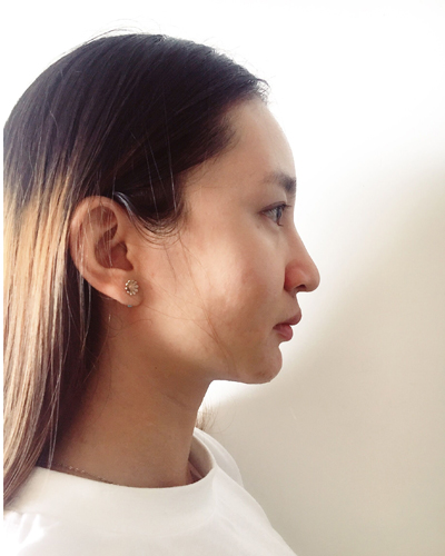 武漢維納斯整形醫(yī)院趙瑾醫(yī)生做玻尿酸墊下巴怎么樣？附玻尿酸墊下巴案例