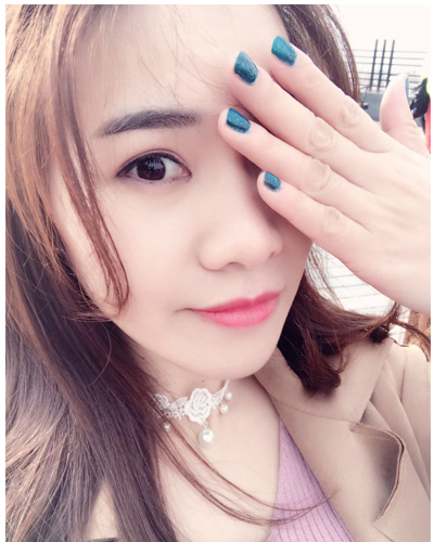 營口臻美醫(yī)療整形醫(yī)生閆迎軍做雙眼皮效果怎么樣？附雙眼皮案例對比圖