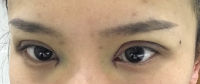 長春麥西美嘉整形醫(yī)生王圣博做雙眼皮手術(shù)效果怎么樣？附雙眼皮案例