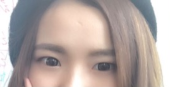 長(zhǎng)春麥西美嘉整形醫(yī)生王圣博做雙眼皮手術(shù)效果怎么樣？附雙眼皮案例