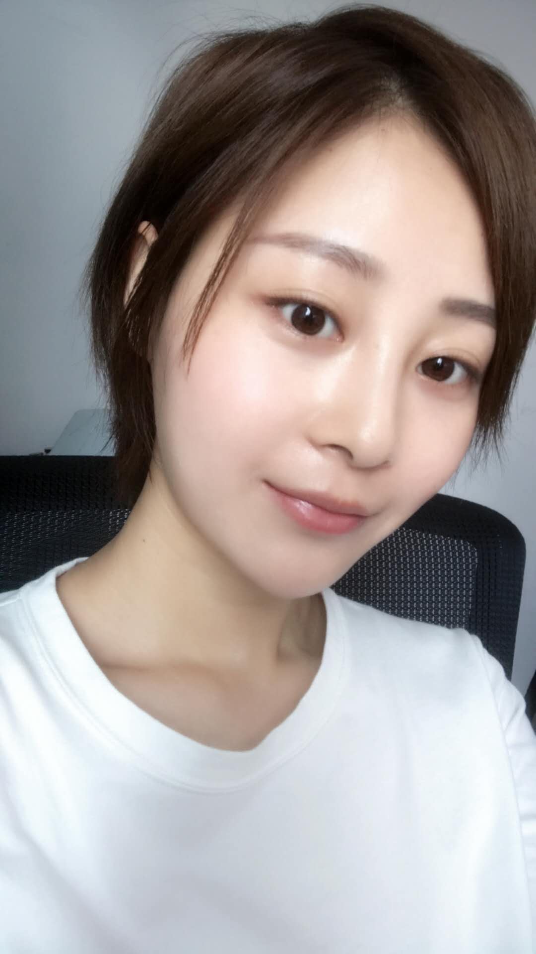天津歐華威莎整形醫(yī)生姚玲做面部埋線提升效果怎么樣？附埋線提升案例
