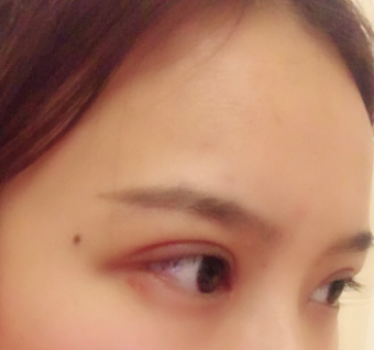 長春麥西美嘉整形醫(yī)生王圣博做雙眼皮手術(shù)效果怎么樣？附雙眼皮案例