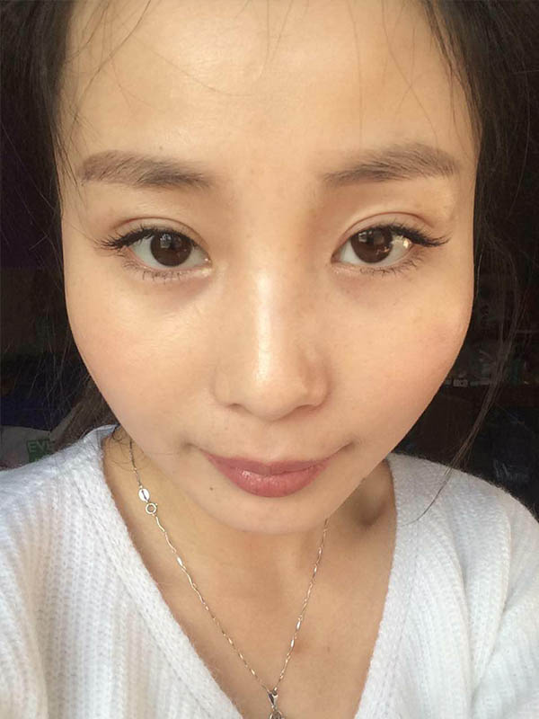 桂林新華醫(yī)療美容醫(yī)生李新華做雙眼皮手術(shù)怎么樣？李新華雙眼皮手術(shù)案例