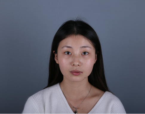 桂林新華醫(yī)療美容醫(yī)生李新華做雙眼皮手術(shù)怎么樣？李新華雙眼皮手術(shù)案例