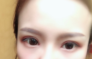 長(zhǎng)春麥西美嘉整形醫(yī)生王圣博做雙眼皮手術(shù)效果怎么樣？附雙眼皮案例