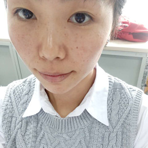 珠海蒂伊醫(yī)療整形醫(yī)生廖俊凱做激光祛斑效果怎么樣？附激光祛斑案例效果圖