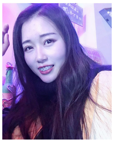 義烏傅氏口腔醫(yī)生朱雨晴做牙齒隱形矯正效果怎么樣？附牙齒隱形矯正案例