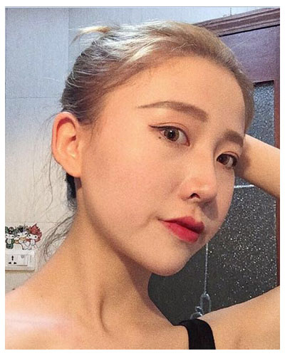 珠海海大整形美容外科黃發(fā)醫(yī)生做面部吸脂怎么樣？附面部吸脂案例
