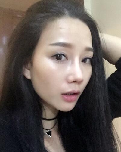西安陽(yáng)光整形醫(yī)院邵萍醫(yī)生做鼻綜合整形怎么樣？附鼻綜合整形案例