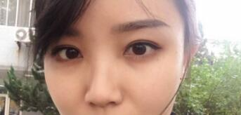 長沙微笑醫(yī)療整形醫(yī)生段雙軍做切開雙眼皮+開內眼角效果怎么樣？附案例
