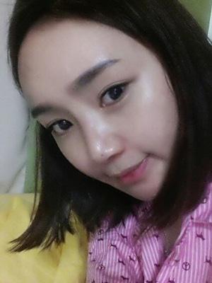 長春中妍整形醫(yī)院吳學軍醫(yī)生做玻尿酸墊下巴+玻尿酸豐太陽穴案例效果對比圖