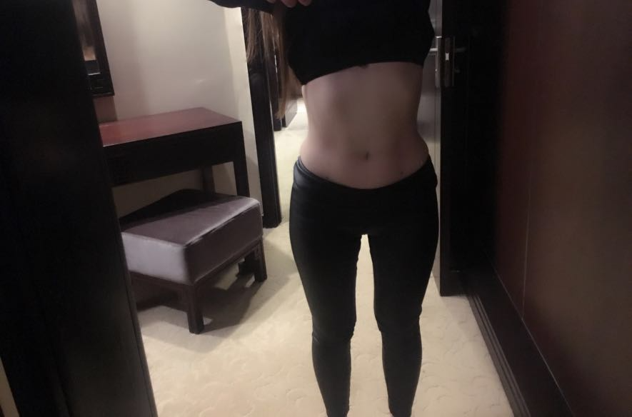 肇慶華美整形醫(yī)院陳巍醫(yī)生做腰腹吸脂效果怎么樣？附腰腹吸脂案例