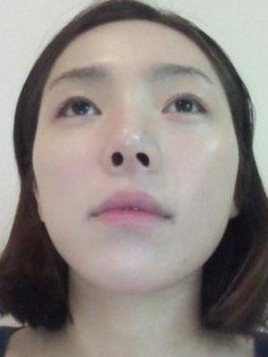 長春中妍整形醫(yī)院吳學軍醫(yī)生做玻尿酸墊下巴+玻尿酸豐太陽穴案例效果對比圖