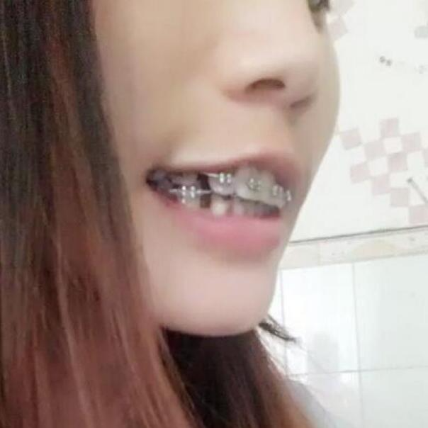 武漢立美整形醫(yī)院張智星醫(yī)生做牙齒矯正效果怎么樣？附牙齒矯正案例