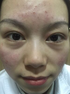 西安壹加壹整形醫(yī)院劉晨醫(yī)生做點(diǎn)陣激光祛痘效果怎么樣？附點(diǎn)陣激光祛痘效果圖