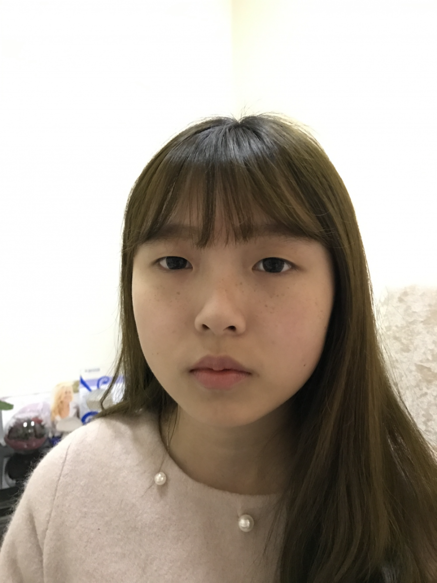 西安米蘭柏羽整形醫(yī)院李旭平做雙眼皮+開眼角技術(shù)怎么樣？附醫(yī)院案例